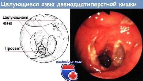 Целующиеся язвы двенадцатиперстной кишки в норме