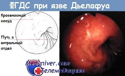 ФГДС при язве Дьелафуа