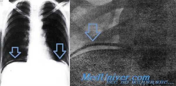 Рентгенография при язве двенадцатиперстной кишки