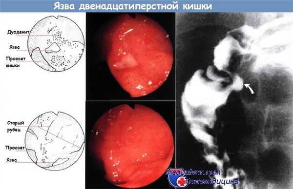 Язва двенадцатиперстной кишки в норме