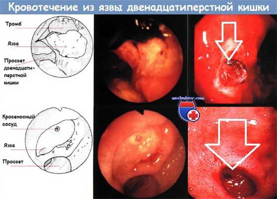 Кровотечение из язвы двенадцатиперстной кишки