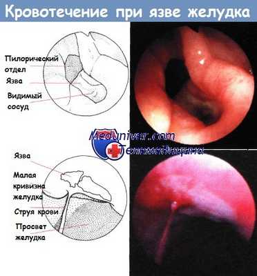 ФГДС при кровотечении из язвы желудка