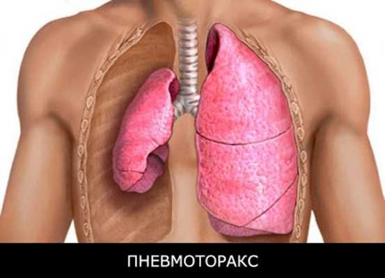 травма грудной клетки