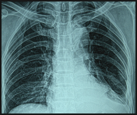 рентген грудной клетки