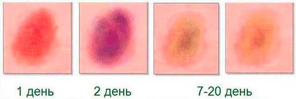 стадии ушиба