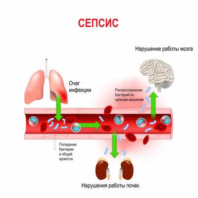 Сепсис_дисфункция.jpg