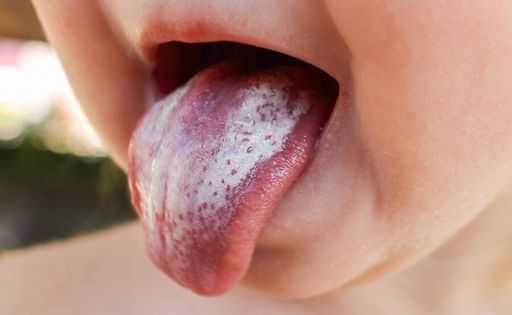 Лечение молочницы у детей