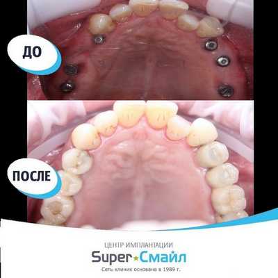 Фото имплантации по технологии All-on-4