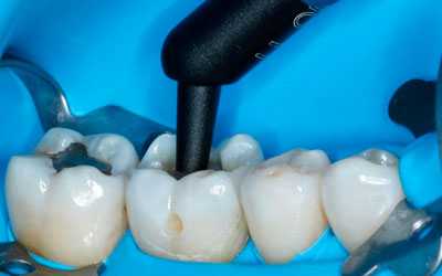 Уникальные материалы для пломбирования в стоматологии - Стоматология Линия Улыбки