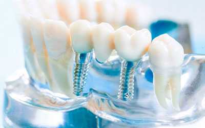 Протезирования зубов - Стоматология Линия Улыбки