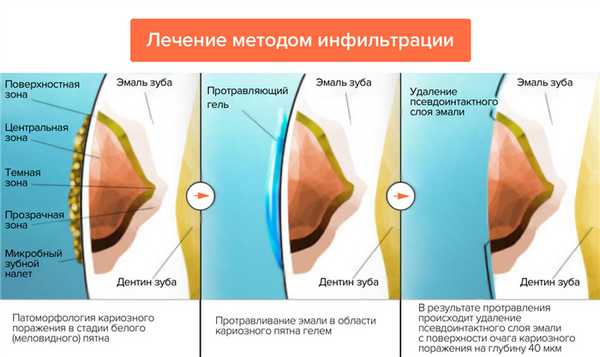 Лечение методом инфильтрации в картинках