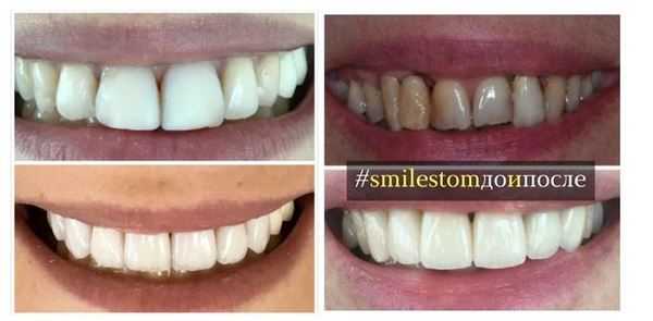 Виниры установлены в клинике «Super Смайл»