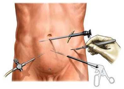 Лапароскопические операции при аденоме простаты