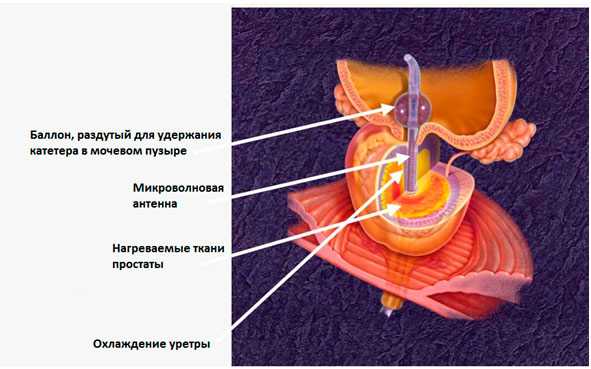 Трансуретральная микроволновая термотерапия