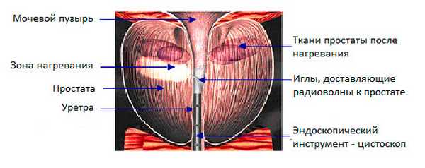 Трансуретральная игольчатая абляция