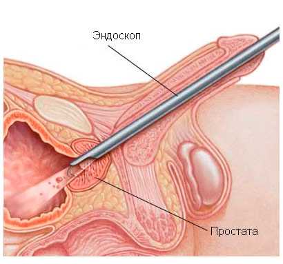 Малоинвазивное лечение аденомы простаты