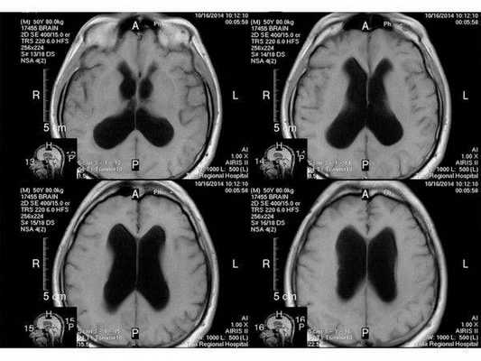 МРТ от 16.10.2014 показывает сужение желудочковой системы на 2 мм