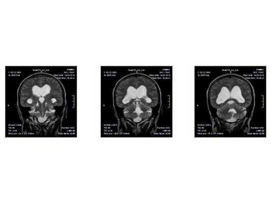 МРТ от 14.05.2013 (за месяц до поступления в нейрохирургическое отделение)