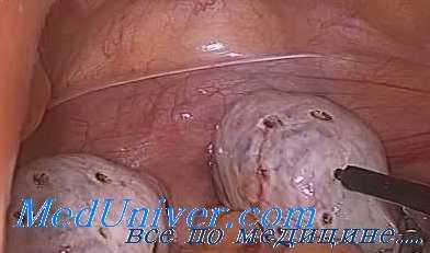 дриллинг яичников