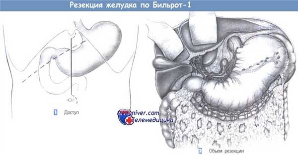 Техника резекции желудка по Бильрот-1