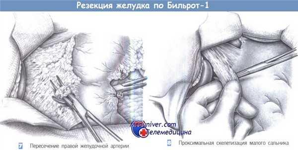Техника резекции желудка по Бильрот-1