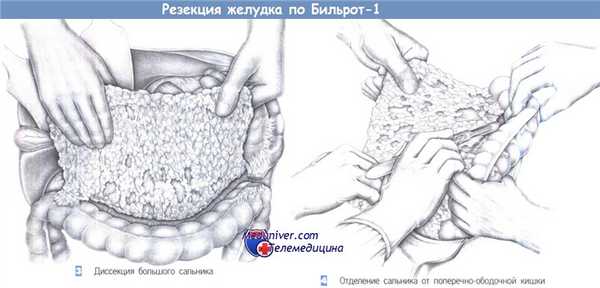 Техника резекции желудка по Бильрот-1