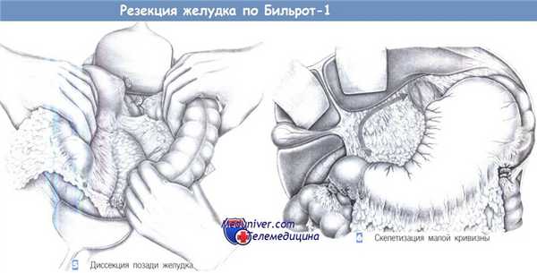 Техника резекции желудка по Бильрот-1
