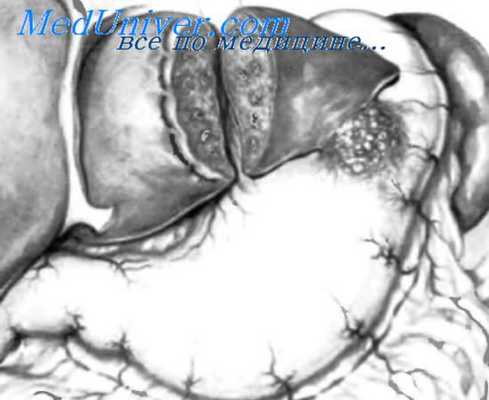 этапы создания анастомоза