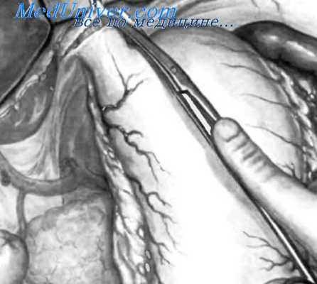 тотальная гастрэктомия