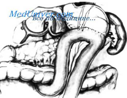 анастомоз при резекции желудка