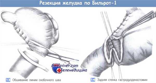 Техника резекции желудка по Бильрот-1