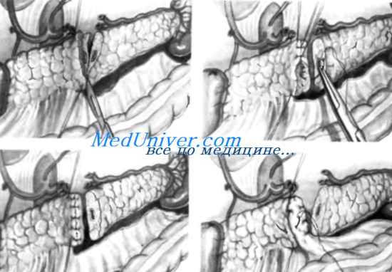 этапы тотальной гастрэктомии