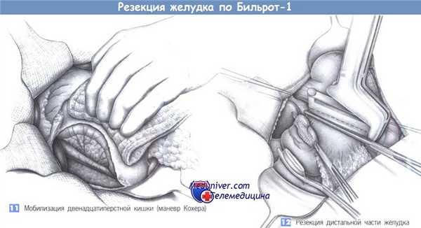 Техника резекции желудка по Бильрот-1