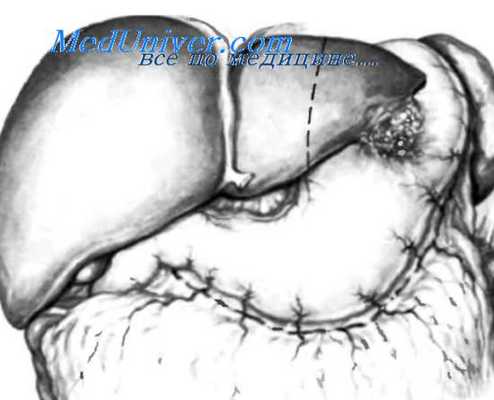 техника анастомоз при резекции желудка