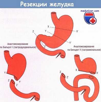 Варианты резекций желудка
