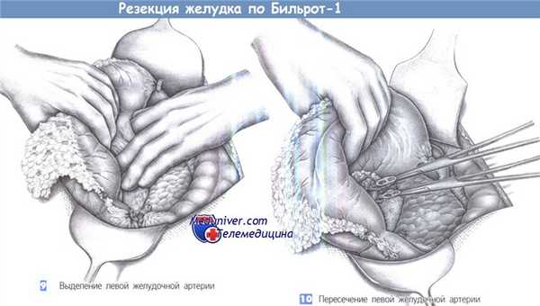 Техника резекции желудка по Бильрот-1