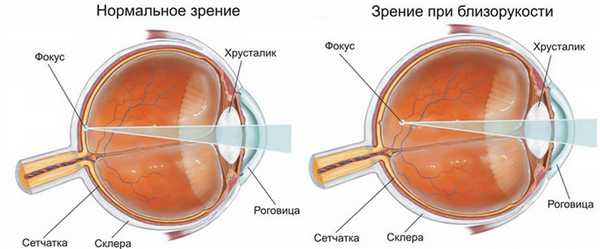 Близорукость, причиной которой является наследственность называется истинной