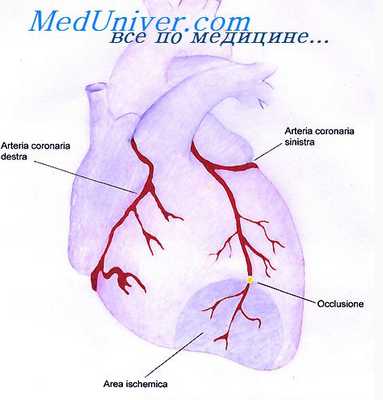 причины стенокардии