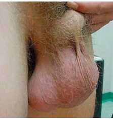 Одностороннее гидроцеле у мужчины