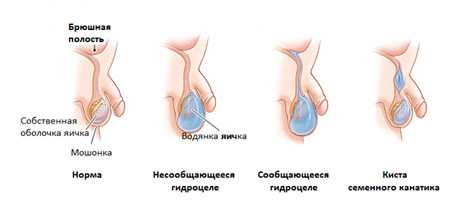 Разновидности водянки яичка