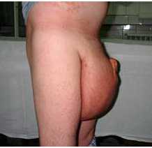 Гигантское гидроцеле