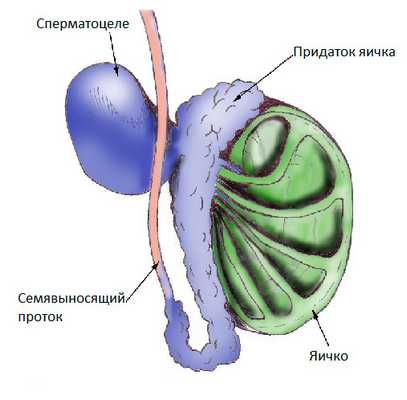 Сперматоцеле
