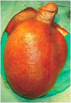 Гидроцеле большого размера