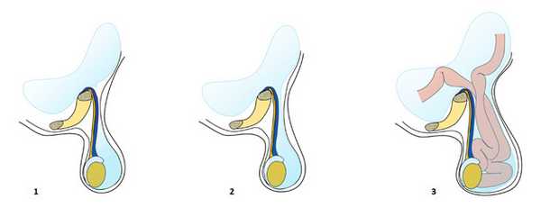 Водянка яичка сообщающегося типа