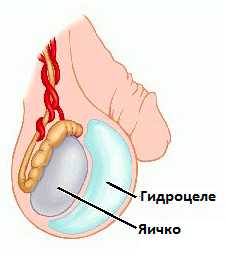 Водянка яичка
