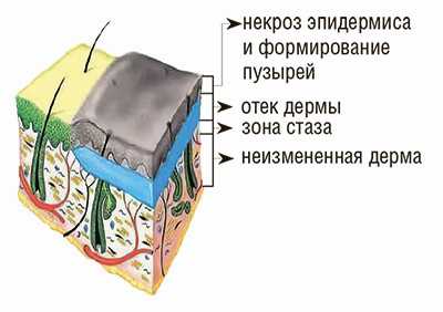 Ожоговая болезнь