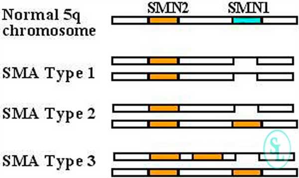 Причина спинально-мышечная атрофии у детей 