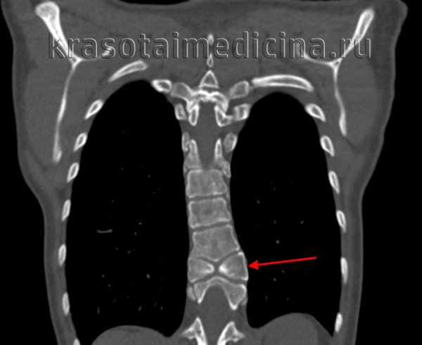 Расщепление позвоночника
