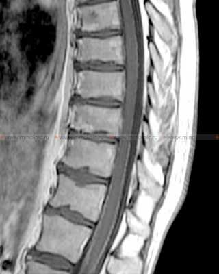 На МРТ спинного мозга после контрастирования визуализируется так называемая