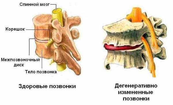 Остеофиты при разрастании имеют свойства сращиваться